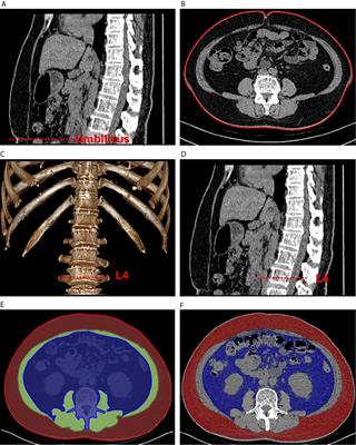 Evaluation of Abdominal Computed Tomography Scans for Differentiating the Discrepancies in Abdominal Adipose Tissue Between Two Major Subtypes of Primary Aldosteronism